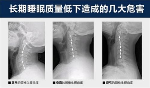 楽寝教你如何根据颈椎曲度正确选枕头